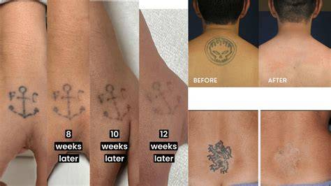 7 Astonishing Tatto Removal Before and After Transformations That Will Leave You Amazed!