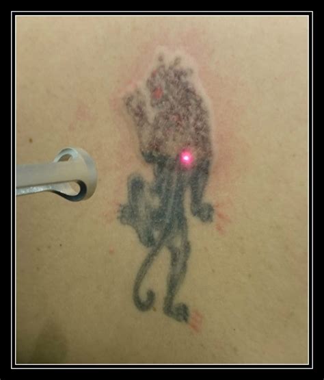 Laser Tattoo Removal London Experts London & Surrey