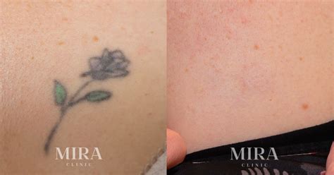 Laser Tattoo Removal In Perth PicoSure & The 532 Red