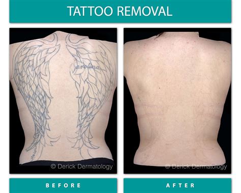 Tattoo Removal Before and After Tattoo removal, Laser