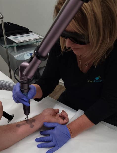 Laser Tattoo Removal Beautilase, North Shore Auckland