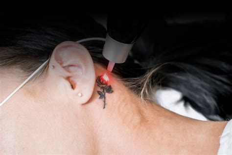 Gallery ABRADE TATTOO REMOVAL