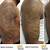 Tattoo Removal Black Skin Before After