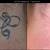 Tattoo Removal Boston