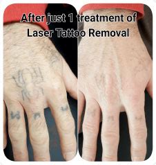 Tattoo Removal Treatment in Bournemouth Laser Skin Solutions