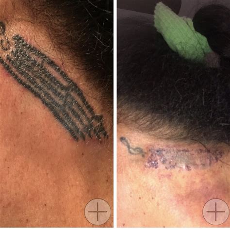 Laser Tattoo Removal in Amherst, Buffalo and Western NY