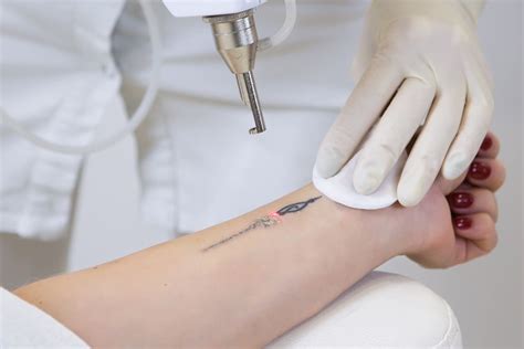 Laser Tattoo Removal How Long Does the Process Take