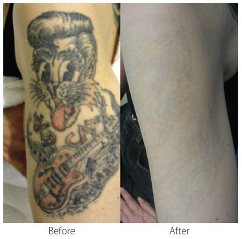 Laser Tattoo Removal Picosure in Calgary YouTube