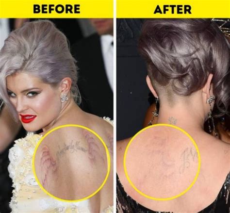 Hena Tattoo 50 Cent Tattoo Removal Before And After Pictures