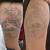 Tattoo Removal Chelmsford