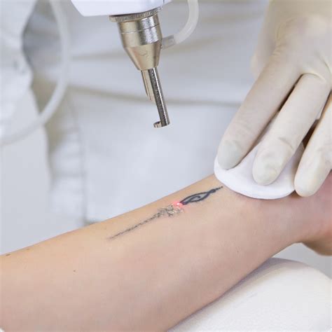 Mobile Laser Tattoo Removal North Wales & Cheshire