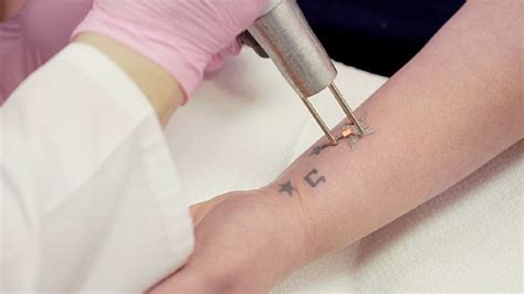 Tattoo Removal In Columbus Ohio Tattoo Removal Columbus