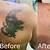 Tattoo Removal Connecticut