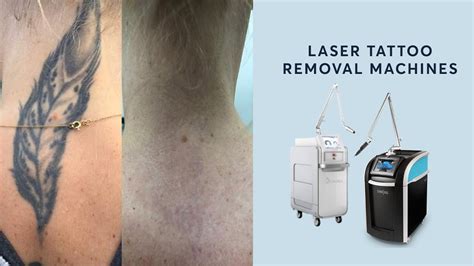 Laser tattoo removal face cleanser Machine EN067 Minxu