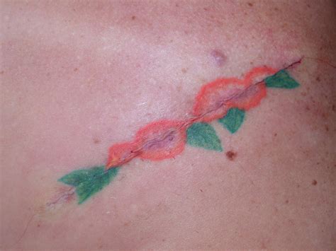 Questions Tattoo Removal Patients Should Ask Before