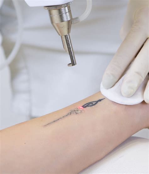Remove Unwanted Ink: Tattoo Removal Services in Greenville, SC
