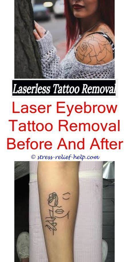 Sugar Land Laser Tattoo Removal Prices In Houston, TX