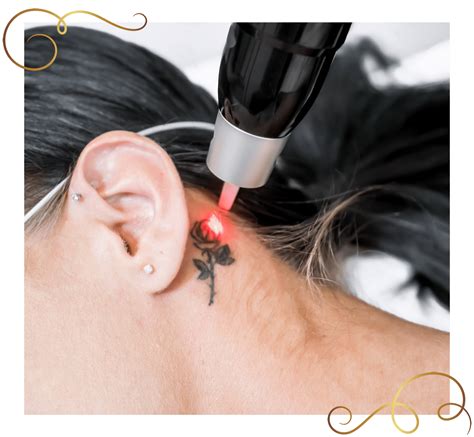 Laser Tattoo Removal Birmingham Virtue Skin Clinics