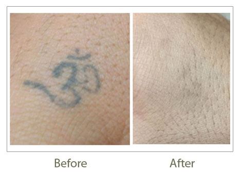 Tattoo Removal in Delhi Permanent Laser Tattoo Removal