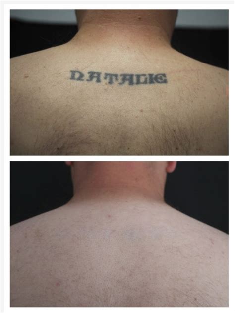 Laser Tattoo Removal New Look Houston