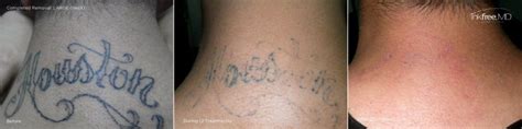 Best Tattoo Removal in Houston Tattoos Remove Laser