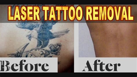 Laser Tattoo Removal Treatment in Hyderabad, India