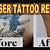 Tattoo Removal In India