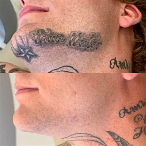 Tattoo Removal in Orlando, Florida Breeze Laser Center