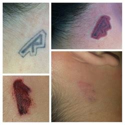 San Antonio's Most Affordable Tattoo Removal