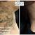 Tattoo Removal Las Vegas