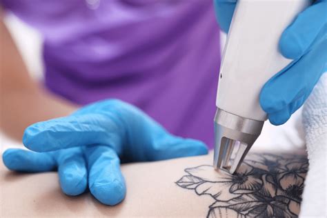 Laser Tattoo Removal in Leicester GLasers