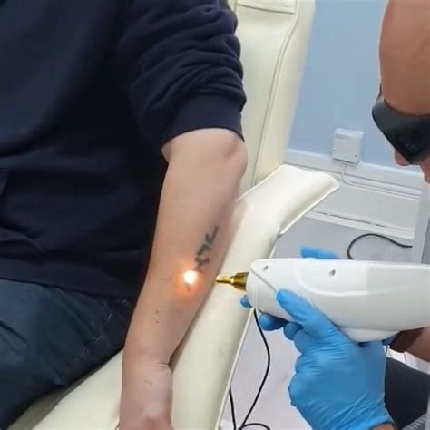 Unwanted Tattoo Removal Buy Dermal Fillers Online