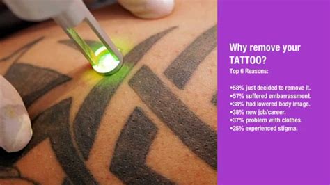 Laser Tattoo Removal Experts Long Island Perfect Body