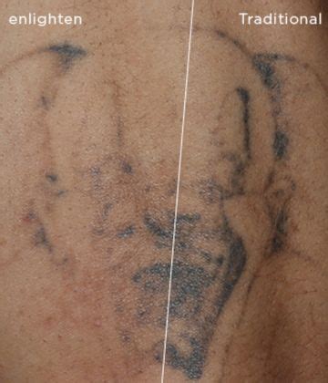 Tattooremoval procedures leave clients 'horrified