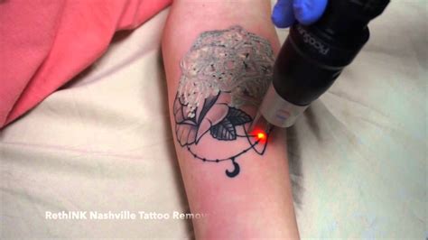 Nashville Laser Tattoo Removal The Picosure YouTube