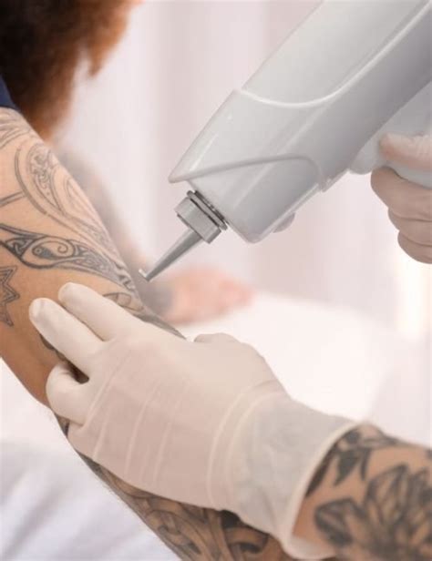 350 for three 5x10cm Laser Tattoo Removal Sessions