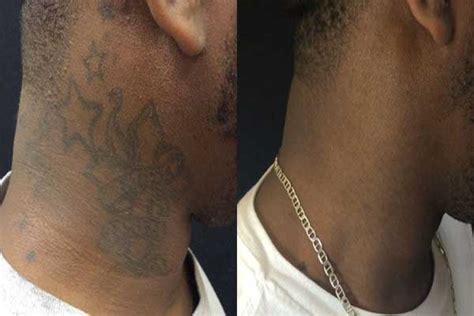 Is Tattoo Removal On Dark Skin Safe? Removery