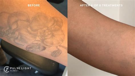 Tattoo Removal Before & After Photos from Astanza