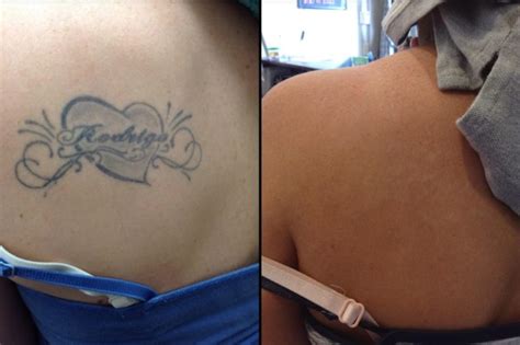 Laser Tattoo Removal Of A Pennsylvania Outline YouTube