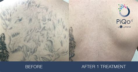 How Effective Is Laser Tattoo Removal? Still Waters Day