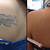 Tattoo Removal Philadelphia