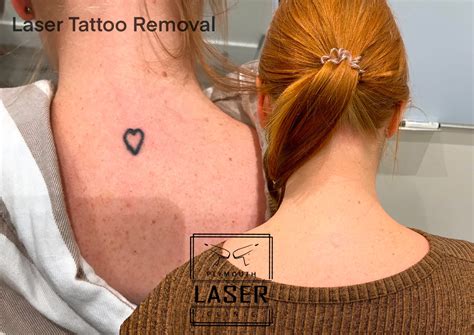 Laser Tattoo Removal in South Devon, Plymouth Whiteroom