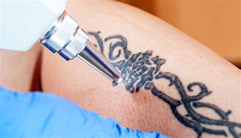 Man Undergoing Laser Tattoo Removal Procedure Stock Photo