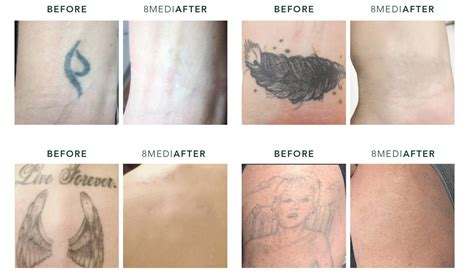 Woman Undergoing Laser Tattoo Removal Procedure Stock