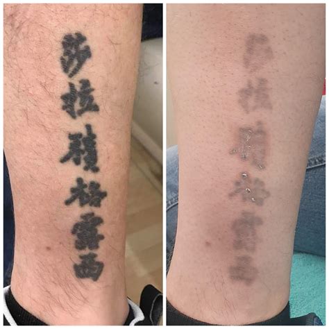 866 best Tattoo Removal In Progress images on Pinterest