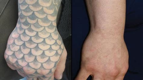 Tattoo Removal Raleigh Nc