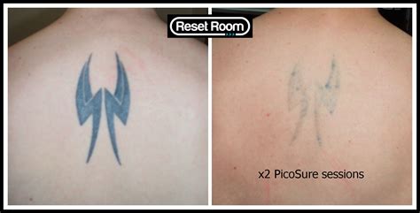 Tattoos Laser tattoo removal, Tattoo removal, Reading tattoo