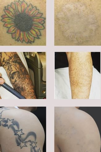 Laser Tattoo Removal Salt Lake City Removery