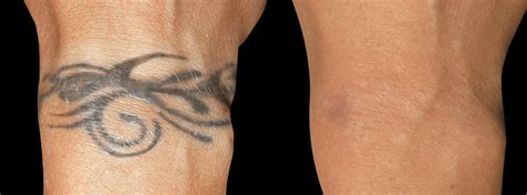 Before After Laser Tattoo Removal Tattoo Removal Laser