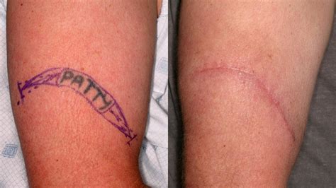 What to Do with Scarring After Laser Tattoo Removal